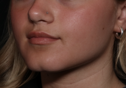 Injectable Fillers Before & After Patient #36166