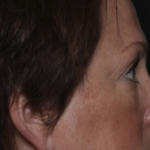 Upper Blepharoplasty Before & After Patient #36036