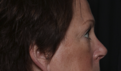 Upper Blepharoplasty Before & After Patient #36036