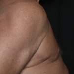Gynecomastia Before & After Patient #36025