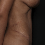 Tummy Tuck Before & After Patient #36047