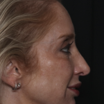 Injectable Fillers Before & After Patient #36124