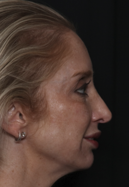 Injectable Fillers Before & After Patient #36124