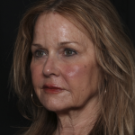Injectable Fillers Before & After Patient #36148
