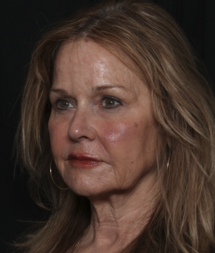 Injectable Fillers Before & After Patient #36148