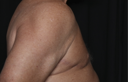 Gynecomastia Before & After Patient #36025