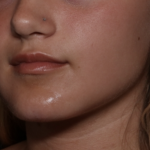 Injectable Fillers Before & After Patient #36166
