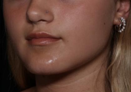 Injectable Fillers Before & After Patient #36166