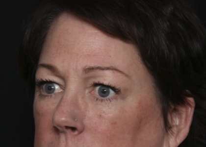 Upper Blepharoplasty Before & After Patient #36036