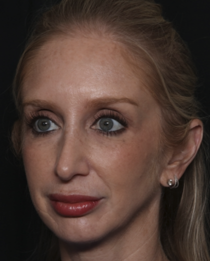 Injectable Fillers Before & After Patient #36124