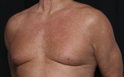 Gynecomastia Before & After Patient #36025