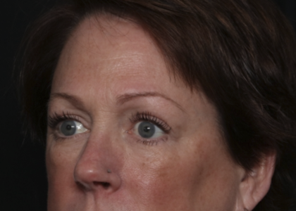 Upper Blepharoplasty Before & After Patient #36036