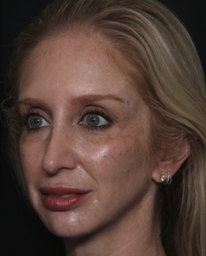 Injectable Fillers Before & After Patient #36124