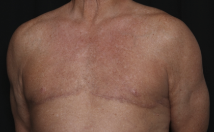 Gynecomastia Before & After Patient #36025