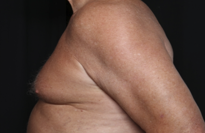 Gynecomastia Before & After Patient #36025