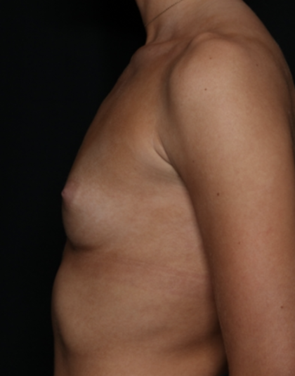 Breast Augmentation Before & After Patient #36185