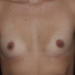 Breast Augmentation Before & After Patient #36149