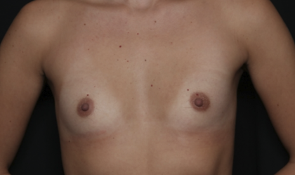 Breast Augmentation Before & After Patient #36149