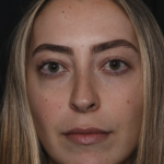 Injectable Fillers Before & After Patient #36125