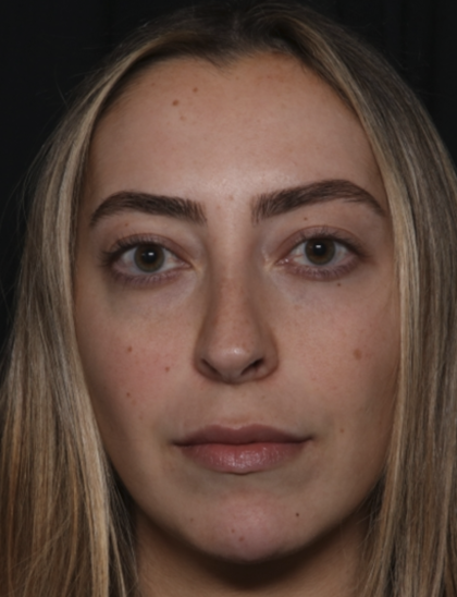 Injectable Fillers Before & After Patient #36125