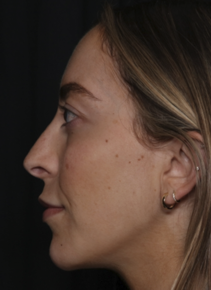 Injectable Fillers Before & After Patient #36125