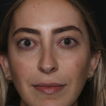 Injectable Fillers Before & After Patient #36125