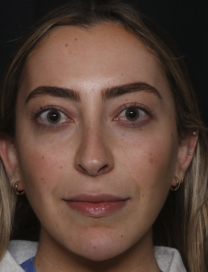 Injectable Fillers Before & After Patient #36125