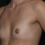 Breast Augmentation Before & After Patient #36149