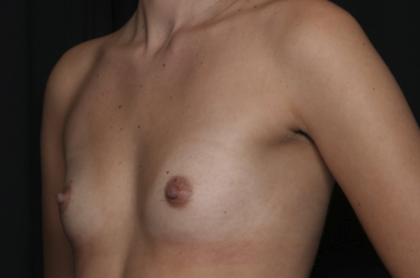 Breast Augmentation Before & After Patient #36149