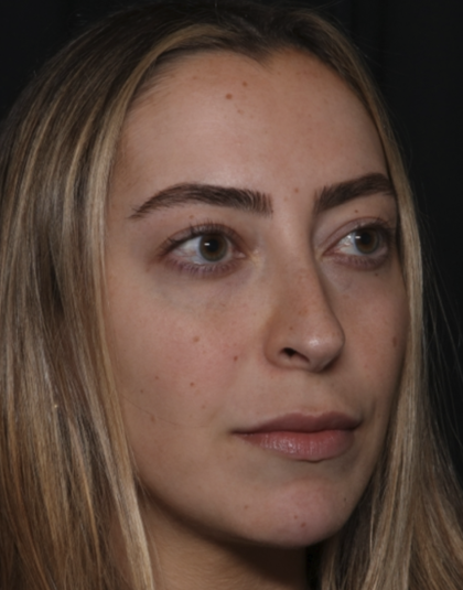 Injectable Fillers Before & After Patient #36125