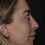 Injectable Fillers Before & After Patient #36125