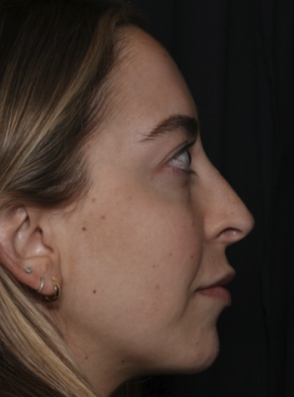 Injectable Fillers Before & After Patient #36125