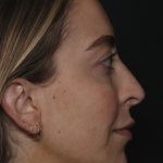Injectable Fillers Before & After Patient #36125