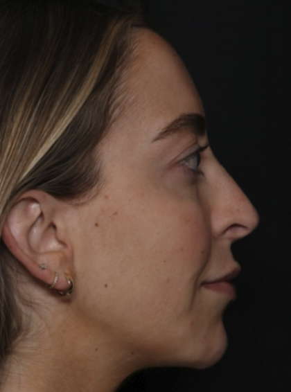 Injectable Fillers Before & After Patient #36125