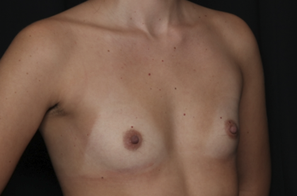 Breast Augmentation Before & After Patient #36149