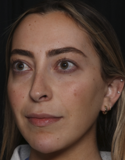 Injectable Fillers Before & After Patient #36125