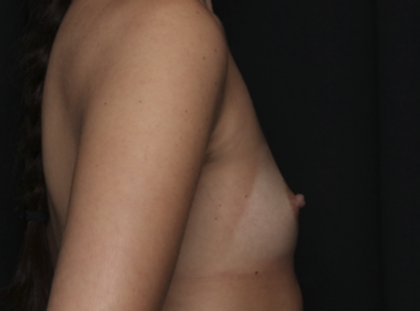 Breast Augmentation Before & After Patient #36149