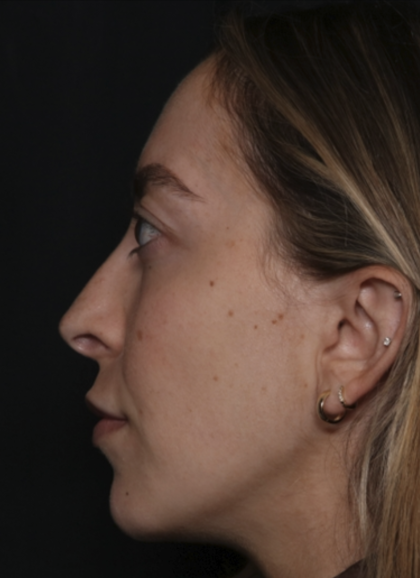 Injectable Fillers Before & After Patient #36125