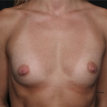 Breast Augmentation Before & After Patient #36083