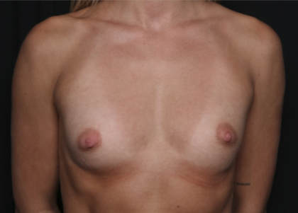 Breast Augmentation Before & After Patient #36083