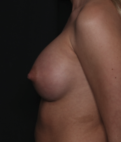Breast Augmentation Before & After Patient #36083