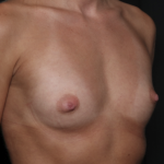 Breast Augmentation Before & After Patient #36083