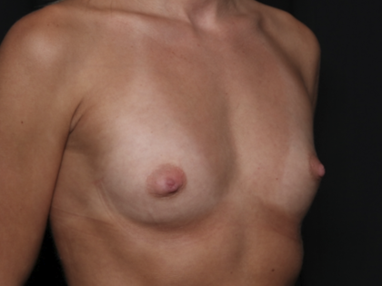 Breast Augmentation Before & After Patient #36083