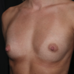 Breast Augmentation Before & After Patient #36083