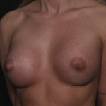 Breast Augmentation Before & After Patient #36083
