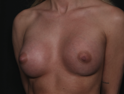 Breast Augmentation Before & After Patient #36083
