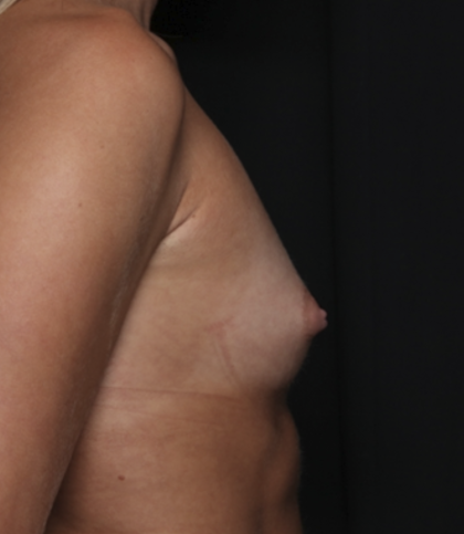 Breast Augmentation Before & After Patient #36083