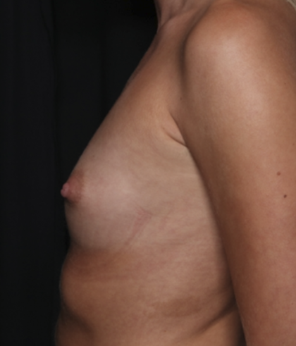 Breast Augmentation Before & After Patient #36083