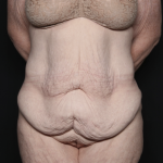 Body Lift Before & After Patient #36082