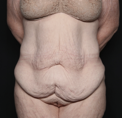 Body Lift Before & After Patient #36082
